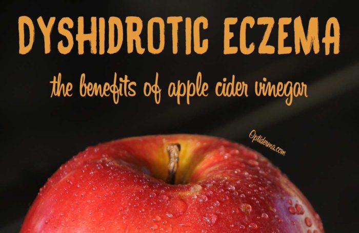 Apple Cider Vinegar For Dyshidrotic Eczemapompholyx The Best Home Remedy 