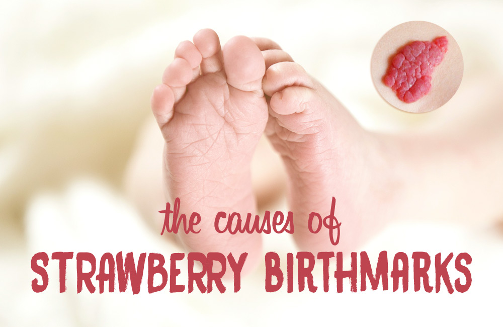 strawberry-birthmarks-in-infants-causes-and-research